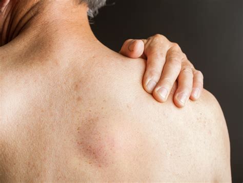 Lump On Shoulder Blade Muscle Keeping These Muscles Strong Will Help