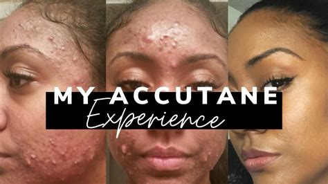 Clearing My Adult Cystic Acne W Pics Honest Accutan3 Experience