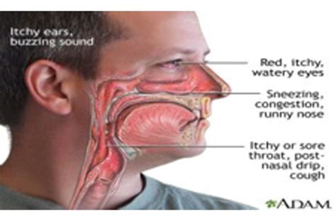 Rhinitis