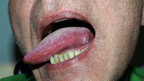 Mouth Cancer On Side Of Tongue