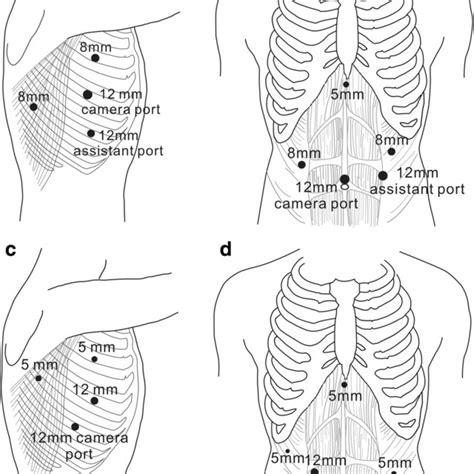 Trocar Placement For Thoracic Part A And Abdominal Part B Of Download Scientific Diagram