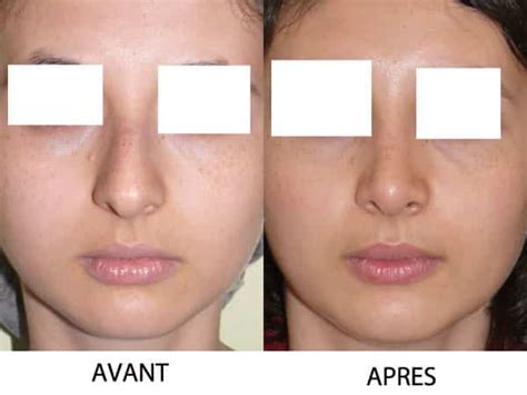 Rhinoplastie De La Pointe Du Nez Paris