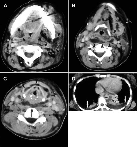 Descending Necrotizing Mediastinitis Caused By An Odontogenic Infection