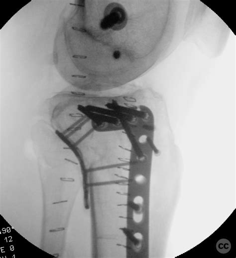 Posterolateral Approach To The Tibial Plateau With Femoral Epicondylar