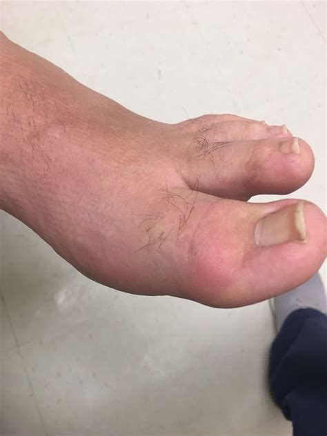 Acute Gout Flare Up Healthmark Foot And Ankle Associates
