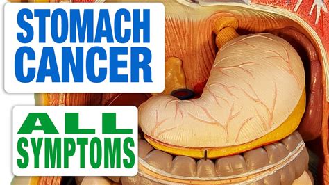 Early Warning Signs Stomach Cancer