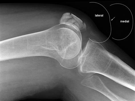 Normal Knee X Rays Bone And Spine