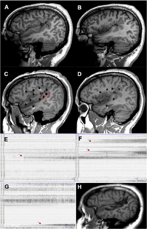 A Patient With Focal Epilepsy Associated With Extensive Right