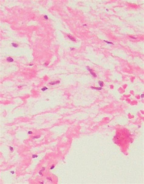 Photomicrograph High Power View Showing Large Histiocytes With Foamy