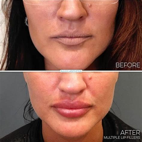 Juvly Aesthetics Juvederm Ultra Plus For Lip Injections