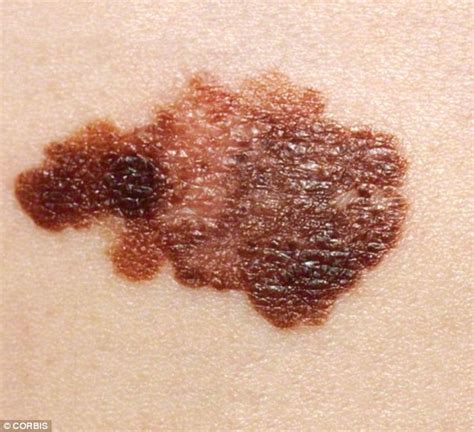 People Carrying The ‘ginger Gene Are At Greater Risk Of Deadly Skin