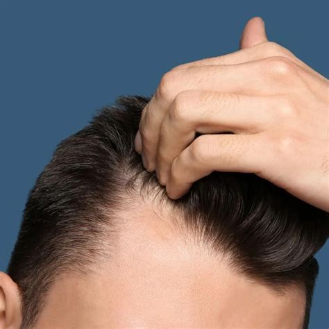 A Complete Guide About Receding Hairline Stages Signs Causes And Tr