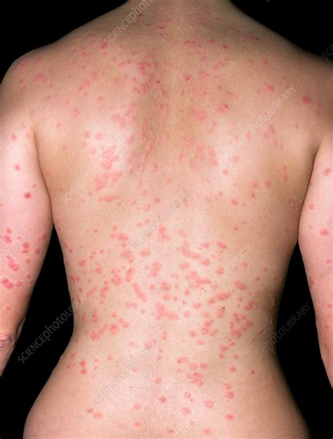 Guttate Psoriasis Stock Image C0372748 Science Photo Library