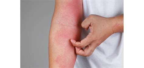 Alergia Al Sol Síntomas Y Remedios Farmayoral