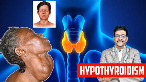 Hypothyroidism Thyroid Gland Problem Thyroid Hormone Tsh Level