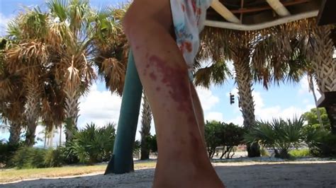 Woman Gets Flesh Eating Bacteria From Beach Youtube
