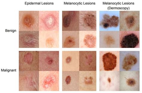 Stages Of Melanoma Growth Patterns And Stages Of Skin Cancer My Xxx