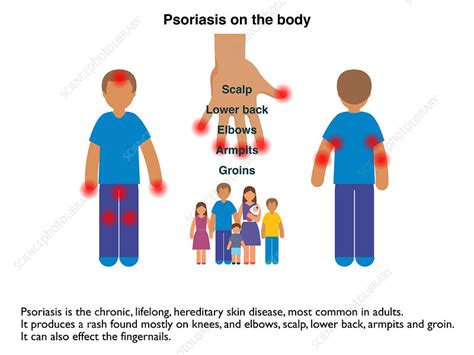 Psoriasis Infographic Stock Image C0437513 Science Photo Library
