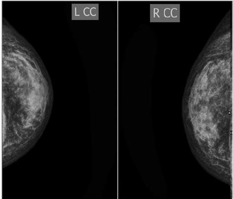 Dense Glandular Tissues In Both Breasts With Mammography Download