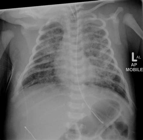 Aspiration pneumonia is caused by the accidental infiltration of food, bacteria, and other substances into the lungs. Meconium aspiration following a prolonged delivery - one ...