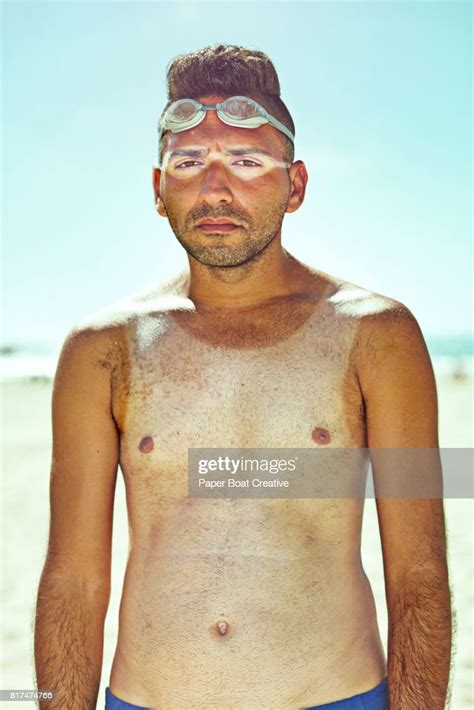 Sunburned Guy With Tan Lines Sad Standing At The Beach In The Summer