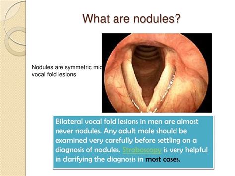 Vocal Cord Nodule