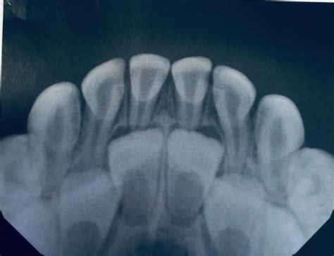 My 4yr Old Daughters Dental X Ray Image Mildlyinteresting