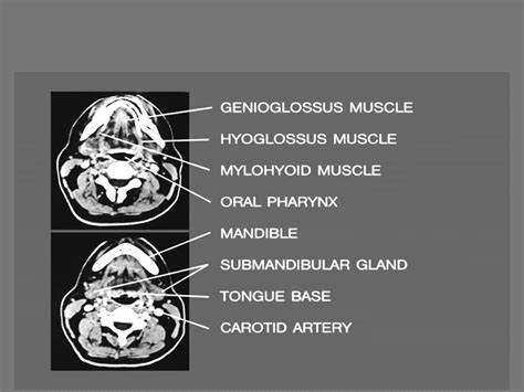 Ct Mri Mouth And Salivary Glands Dr Ahmed Eisawy Youtube