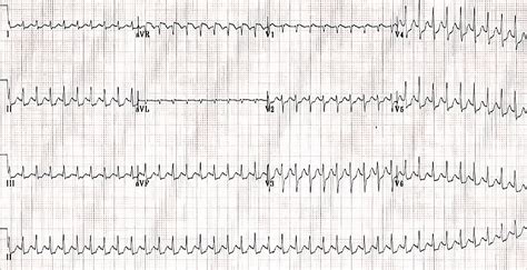 Supraventricular Tachycardia Svt Heart Sexiezpix Web Porn