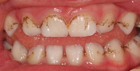 Black Stains On The Teeth Major Causes And Best Solutions Md