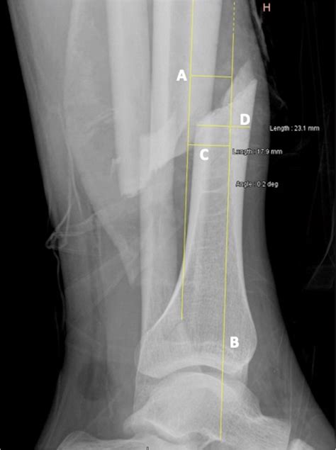 Plain Lateral Radiograph Of A Left Distal Leg Including The Ankle With Sexiezpicz Web Porn
