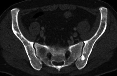 Systemic Mastocytosis Involving Pelvic Bones Ct Scan Of Pelvis Showing