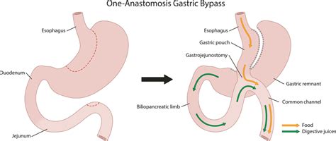 One Anastomosis Gastric Bypass Download Scientific Diagram