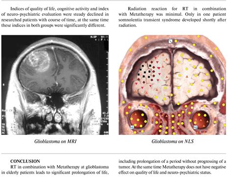 Combined Radiation Therapy And Metatherapy Of Glioblastoma In Elderly