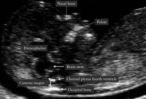 Cisterna Magna Width At 1113 Weeks In The Detection Of Posterior Fossa