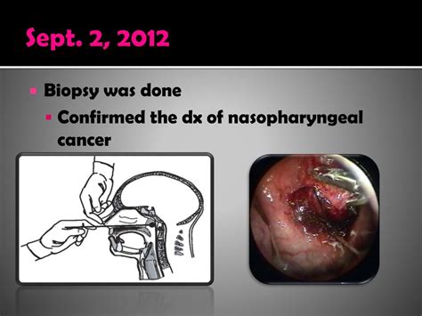 Ppt Nasopharyngeal Carcinoma Powerpoint Presentation Free Download