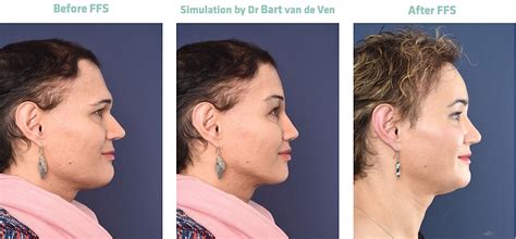 Facial Feminization Surgery Get Your Own Picture Simulation For
