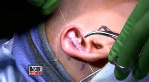 6 Year Old Utah Boy Gets Plastic Surgery For His Elf Ears After He
