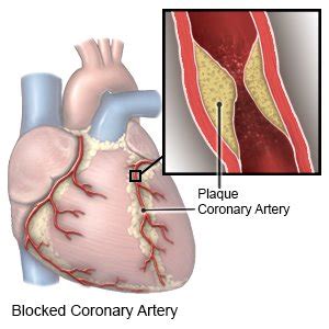 Coronary Artery Disease What You Need To Know