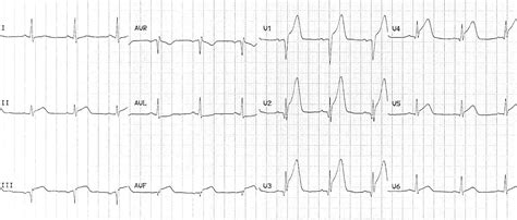 Anterior Myocardial Infarction LITFL ECG Library Diagnosis