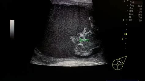 Galactocele Ultrasound Youtube