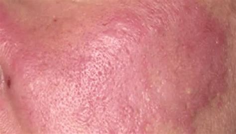 Lupus Skin Rash Symptoms