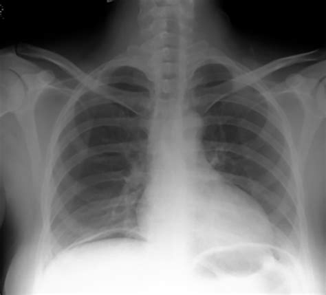 Upright Chest Plain Radiograph X Ray Showing Free Air Gas Under My