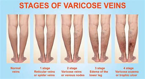 Varicose Veins Explained Causes And Treatments Searchgo