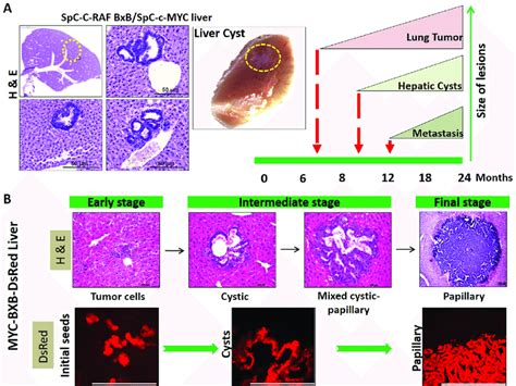 Hepatic Cysts Represent The Early Stage Of Metastasis In Nsclc As Download Scientific Diagram