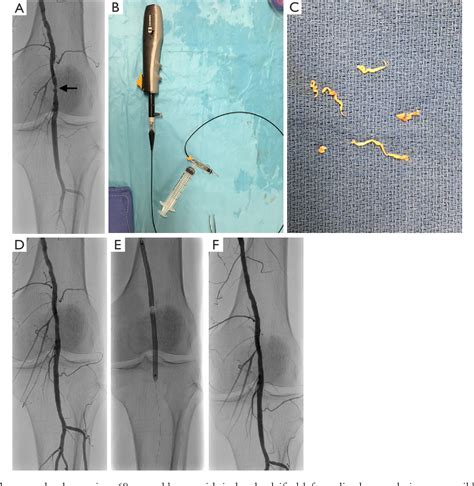 Figure 1 From Combined Hawkone Directional Atherectomy And Paclitaxel