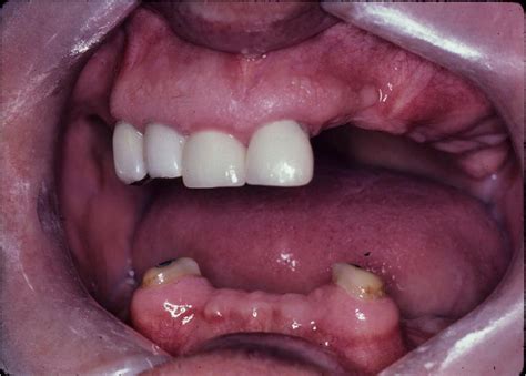 Dentistry Lectures For Mfdsmjdfnbdeore A Short Note On Overdentures