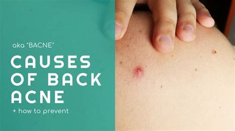 What Are The Causes Of Back Acne How To Treat Back Acne