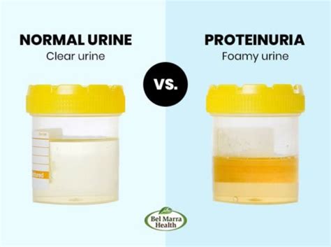 Proteinuria (High Protein in Urine): Causes, Complication and Symptoms