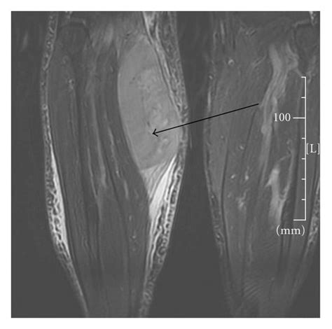 Mri Of The Lower Extremities With Right Leg Mass Involving The Medial